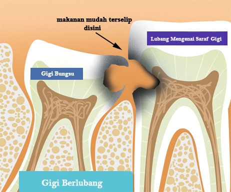 Geraham Bungsu Bikin Sakit Tak Habis Habis Halaman All Kompasiana Com