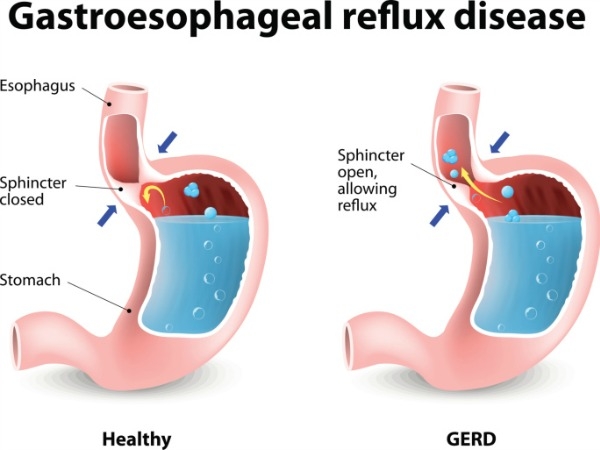Ilustrasi GERD