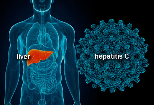Hepatitis C yang Tidak Diperjelaskan oleh Doktermu Halaman all -  Kompasiana.com