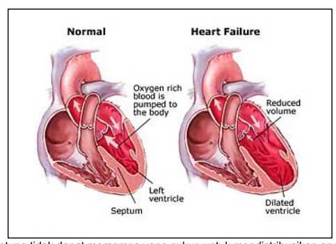 Image result for gagal jantung