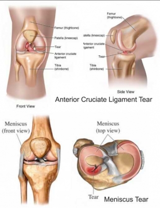 Kesaksianku Bergelut Dengan Cidera Acl Selama 20 Tahun Halaman All Kompasiana  Kesaksianku Bergelut Dengan Cidera Acl Selama 20 Tahun Halaman All Kompasiana