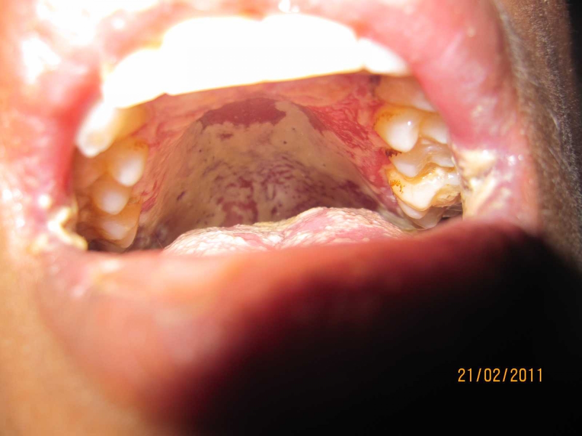 HIV AIDS Infeksi Jamur Rongga Mulut dan Masalah Sosial HIV AIDS Infeksi Jamur Rongga Mulut dan Masalah Sosial