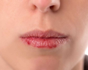Atasi Bibir Kering Dan Pecah Pecah Dengan 5 Bahan Alami Ini Halaman All Kompasiana Com
