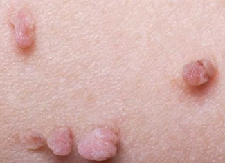 Penyebab Munculnya Kutil Kelamin Apa Saja Kompasiana Com