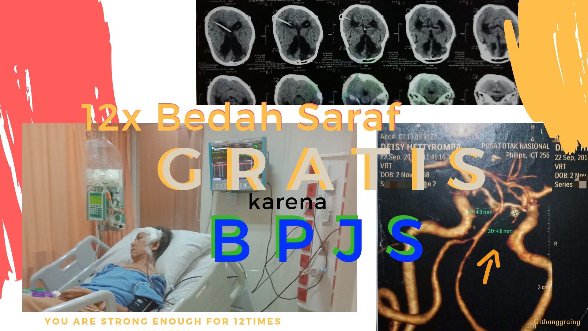 Dua Belas Kali Operasi Bedah Saraf Gratis Berkat BPJS Oleh Githa