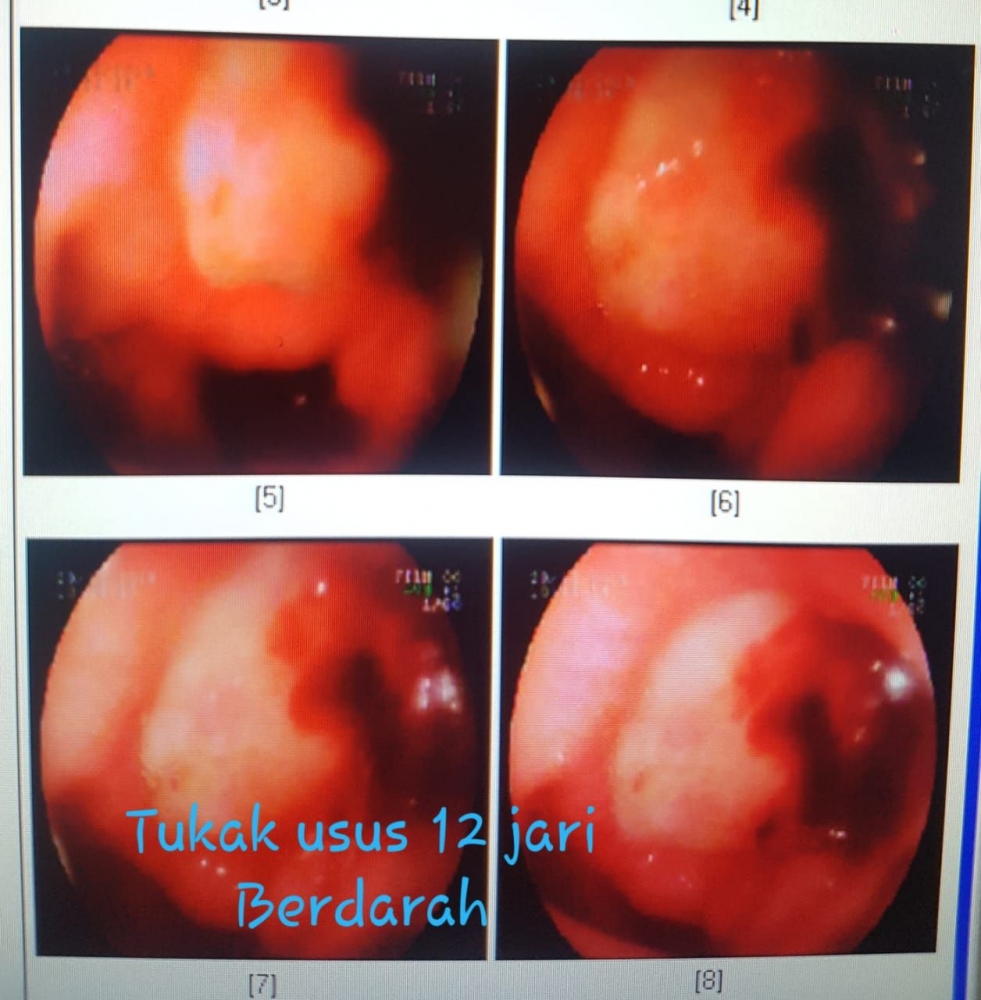 Muntah Darah Dapat Disebabkan Oleh Kuman Helicobacter Pylori Kompasiana Com