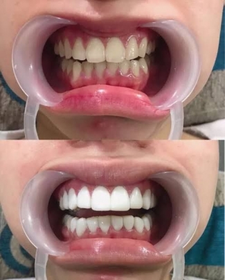 Semua Yang Perlu Anda Ketahui Sebelum Melakukan Veneer Gigi Halaman 1 Kompasiana Com