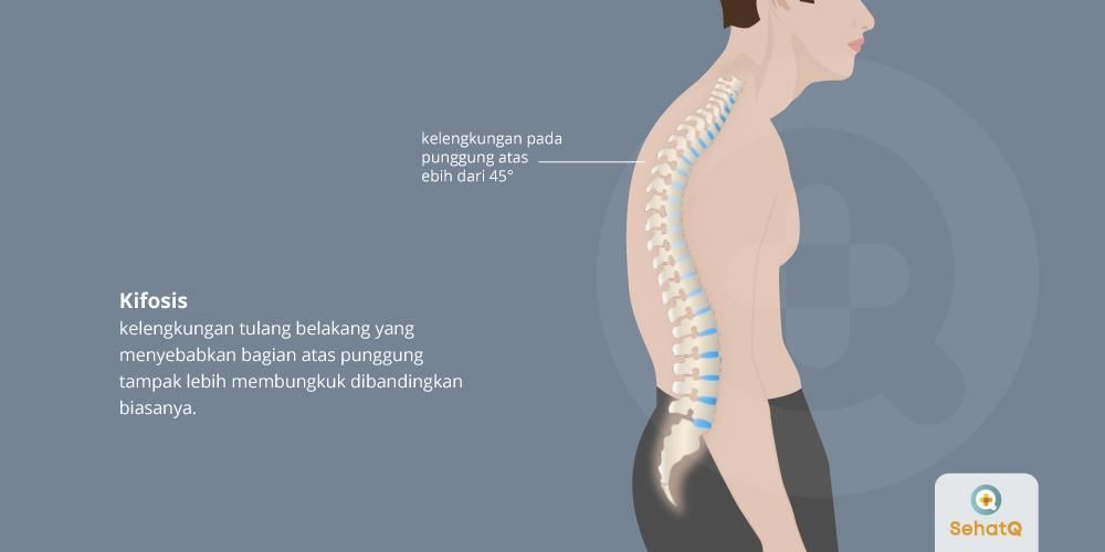 Mengenal Kifosis Sakit Bungkuk Yang Juga Serang Anak Anak Kompasiana Com