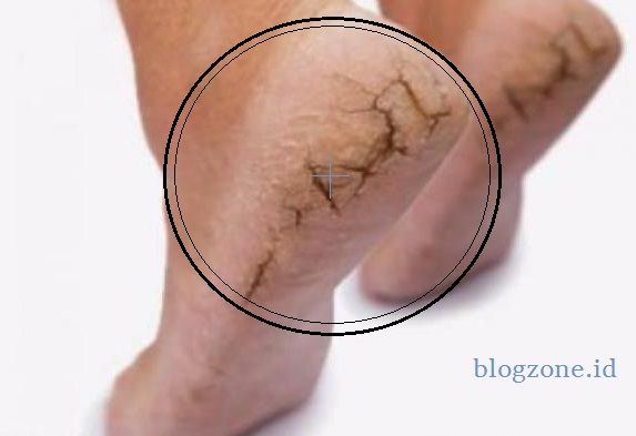 Inilah 5 Penyebab Kaki Pecah pecah yang Perlu Diketahui Inilah 5 Penyebab Kaki Pecah pecah yang Perlu Diketahui