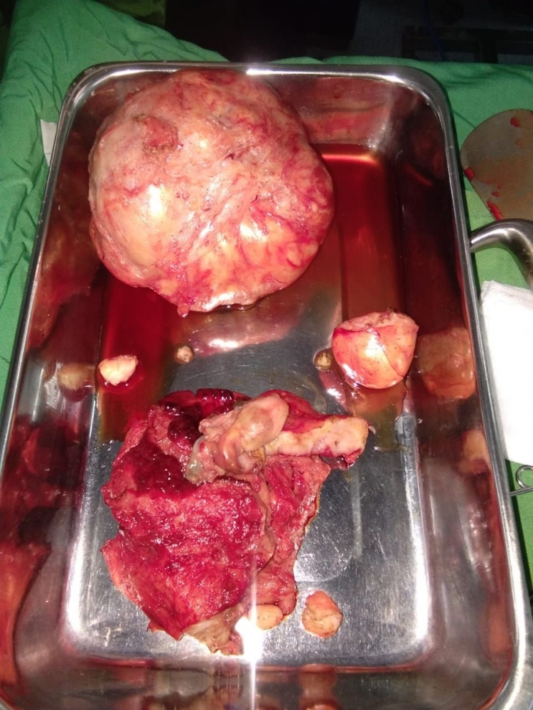 Pengalaman Operasi Miom dan Kista Coklat, Surgery is the