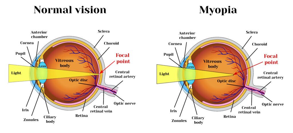 miopia este responsabilă de gene educație pentru deficiențe de vedere