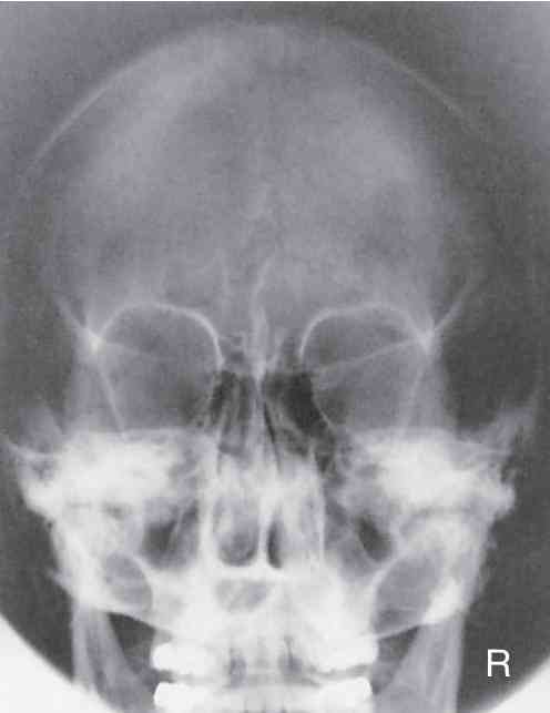 Pemeriksaan Radiografi Skull Caldwell Halaman 1 - Kompasiana.com