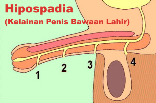 hipospadias penis