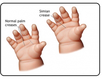 Hati Hati Bila Telapak Tangan Berpola Simian Line Kompasiana Com