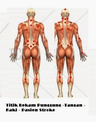 Terapi Stroke Dengan Bekam Cupping Blood Kompasiana Com