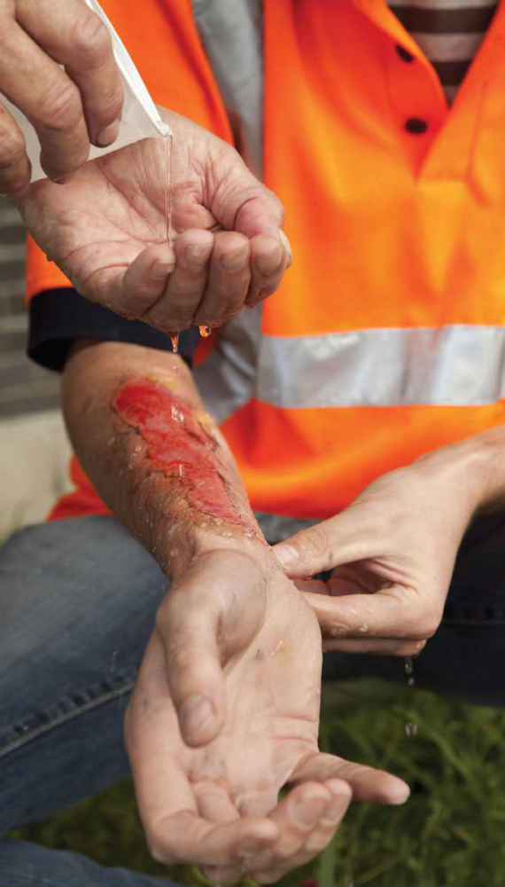 Mengenal Luka Bakar Kompasiana Com