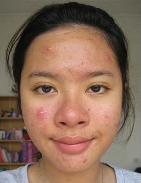 6 Cara Alami Menghilangkan Bekas Jerawat dalam 8 Hari oleh 6 Cara Alami Menghilangkan Bekas Jerawat dalam 8 Hari oleh