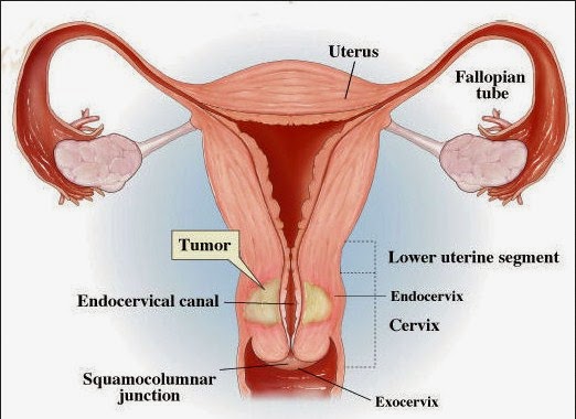 Cara Menyembuhkan Kanker Serviks Secara Herbal Kompasiana Com