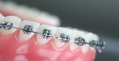 Tiga Bulan Pertama Memakai Kawat Gigi Kompasiana com Tiga Bulan Pertama Memakai Kawat Gigi Kompasiana com